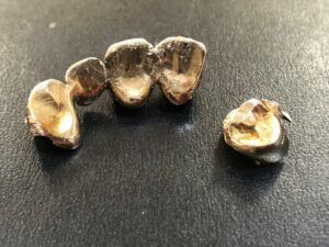 【全国約300店舗を展開するジュエルカフェが調査】捨てる前に待って、その金歯――金属部分5グラムで9万円前後の可能性も