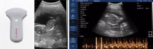 スマートエコーと鳥取大医学部、妊婦の超音波画像から母児リスク検知するAIモデルを共同開発へ