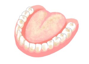 歯垢がつきやすい人は舌苔が多く細菌の栄養となりうるアミノ酸も多いと判明